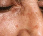 age spots, skin sun damage, excess melanin, freckles, chemical peel, dermabrasion